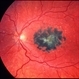 Oxalosis Oxalosis